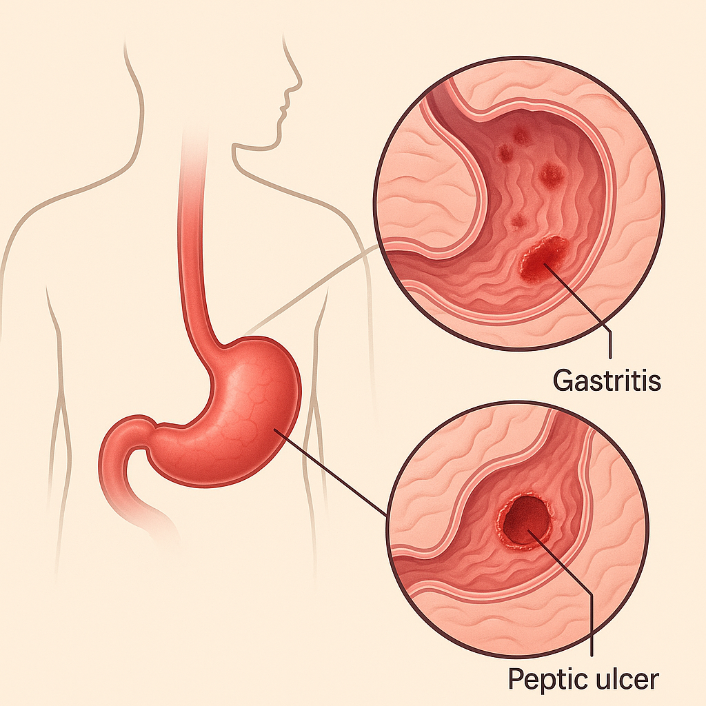 위염 위궤향 치료 예방 음식