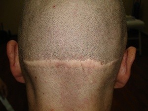 모발이식 3000모 비용