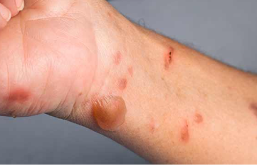 화상물집-치료방법