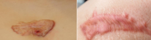 켈로이드 피부 사례 사진입니다.