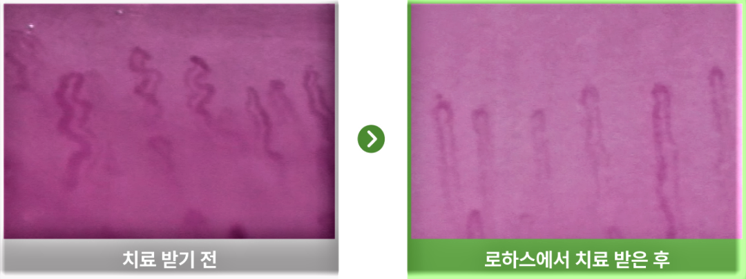 금진옥액요법을 통한 모세혈관 치료 전후 비교 사진