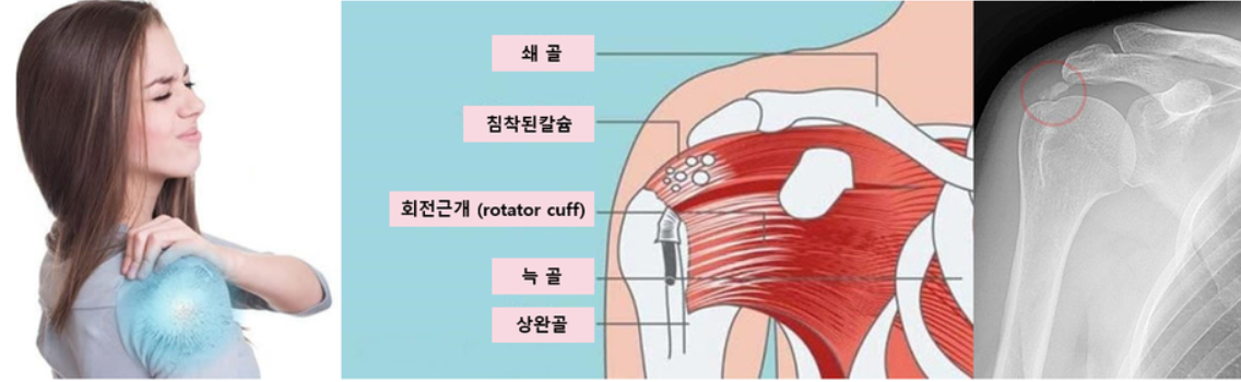 석회가 낀 어깨 이미지 사진