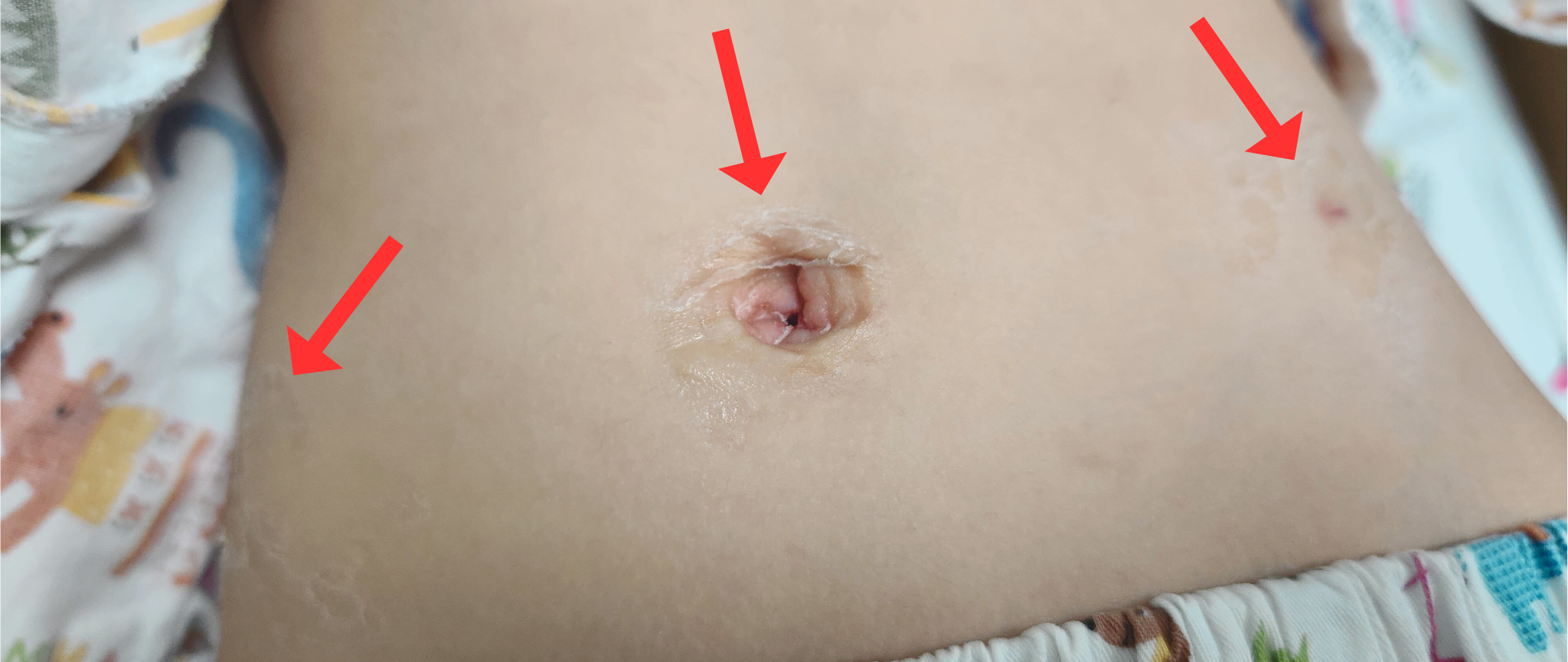 어린이-복강경-탈장수술