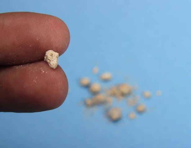 신장 결석 증상 4가지