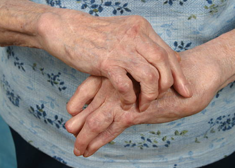 류마티스 관절염