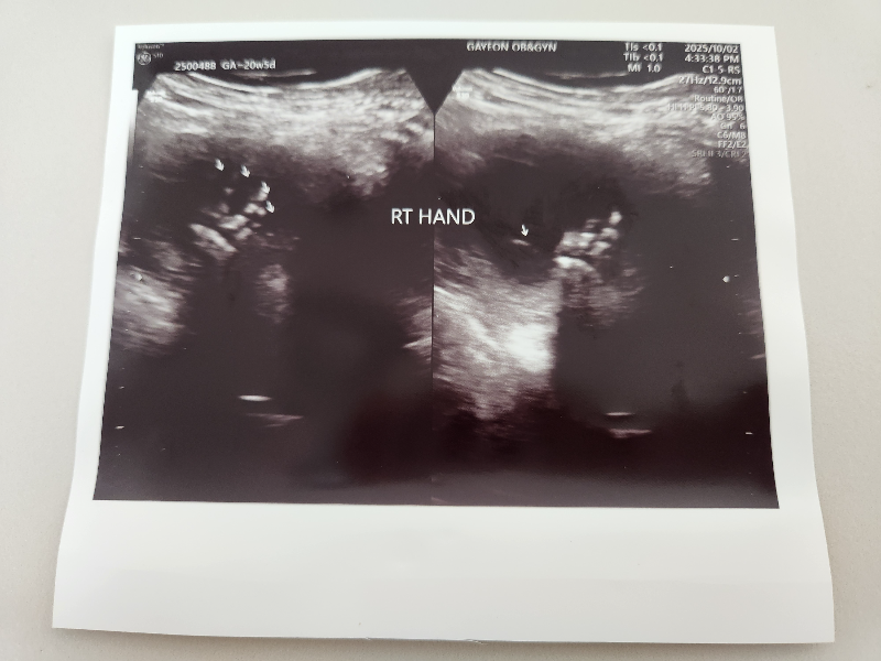 2차 정밀 초음파