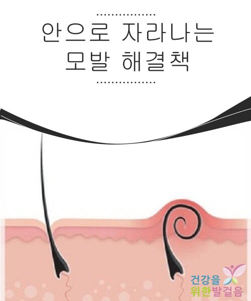 인그로운 헤어의 표본 사진