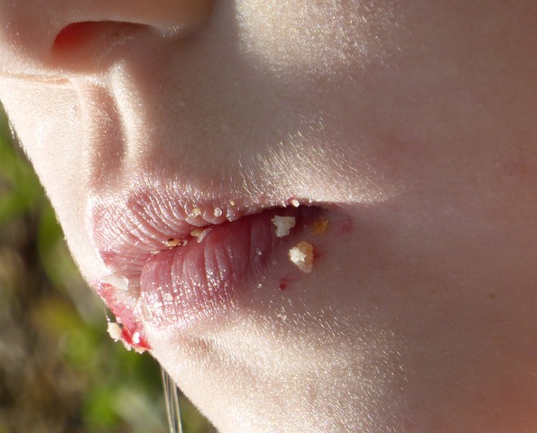 베체트병 원인과 ,구강궤양 연관성 관련 사진