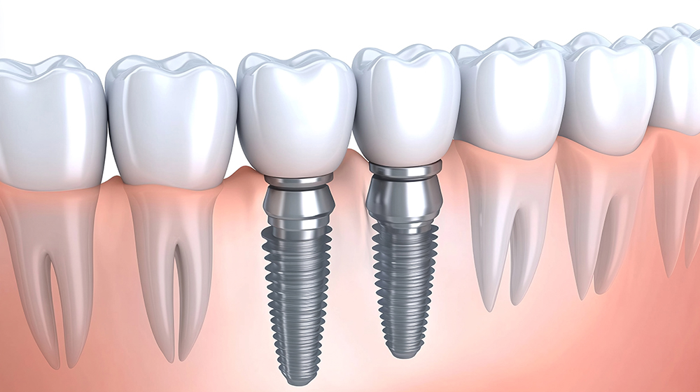 임플란트 의료보험적용대상