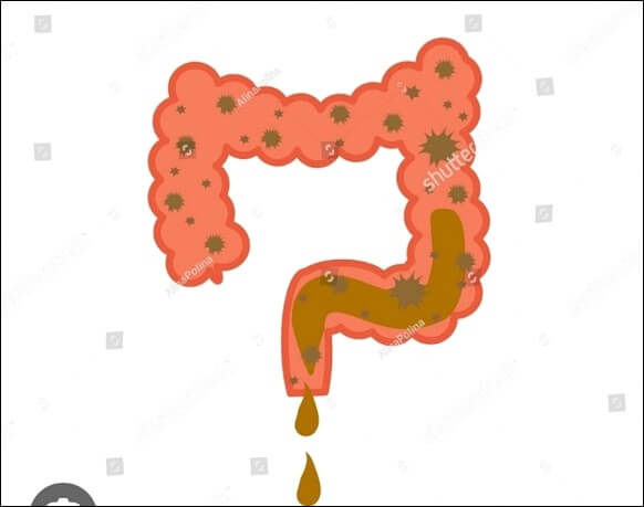 왼쪽 아랫배 통증 원인과 치료법