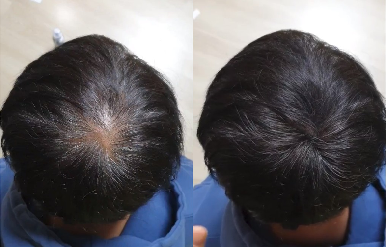 탈모치료 탈모약 모발이식 탈모샴푸 흑채스프레이