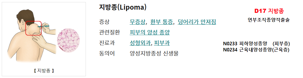 지방종수술