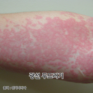 햇빛-알레르기-증상