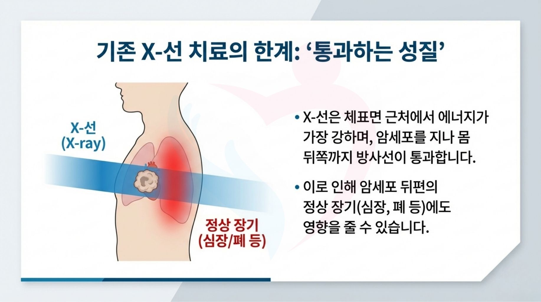 일본 중부국제의료센터 양성자치료 최신장비 ProBeam360