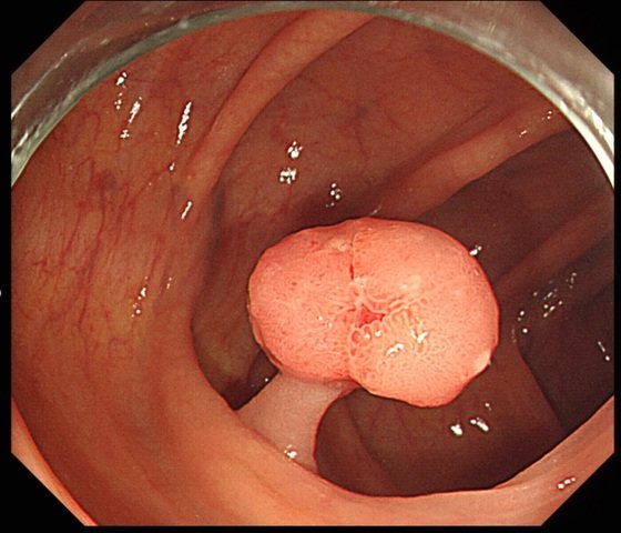 대장암 초기증상
