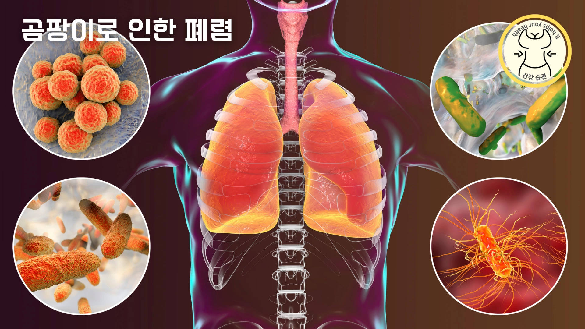 곰팡이로 인한 폐렴