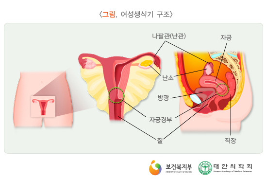 자궁근종 증상