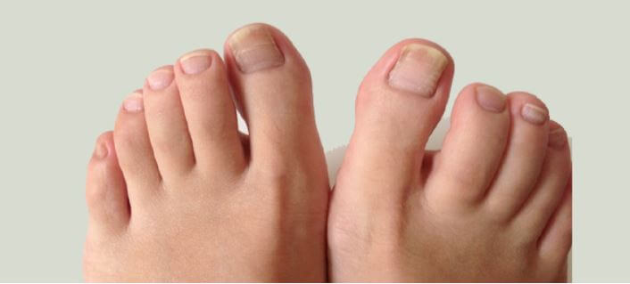 발톱 무좀 상태