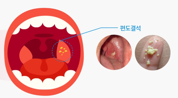 편도결석