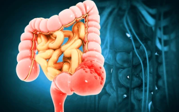 위암 2기 생존율