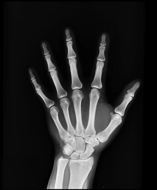 관절 영양제 보스웰리아 추천