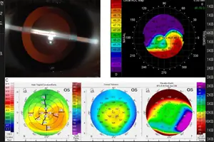 라식 라섹 차이