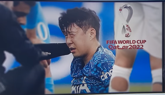 손흥민 수술 성공적