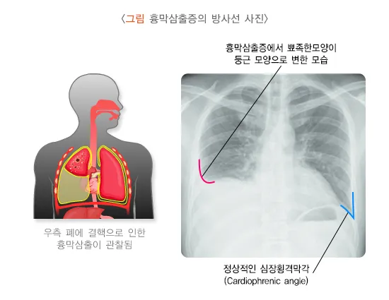 폐에 물이 차는 원인 증상 물참 관리 포인트에 대한 건강정보_6