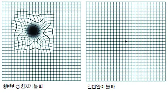 시야에 검은점 시야에 까만점이 보일때 원인과 대처법_3