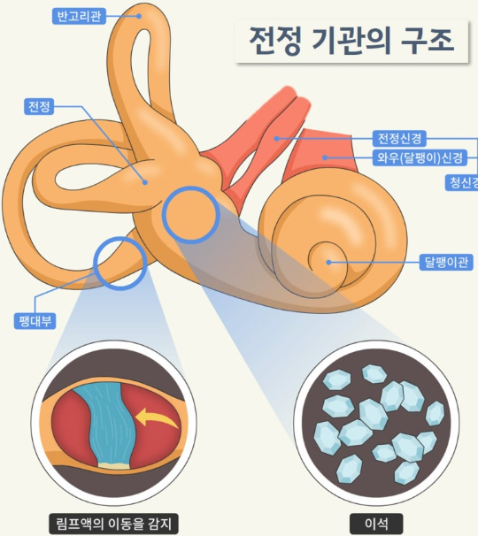 이석증 재발 막는 법