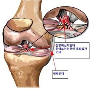 무릎십자인대파열