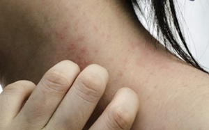 알루미늄 알레르기