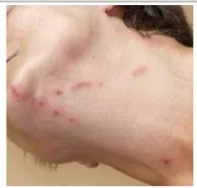 빈대 퇴치제 빈대 물린 자국