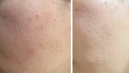 라비오라 레몬꿀팩 before&amp;after