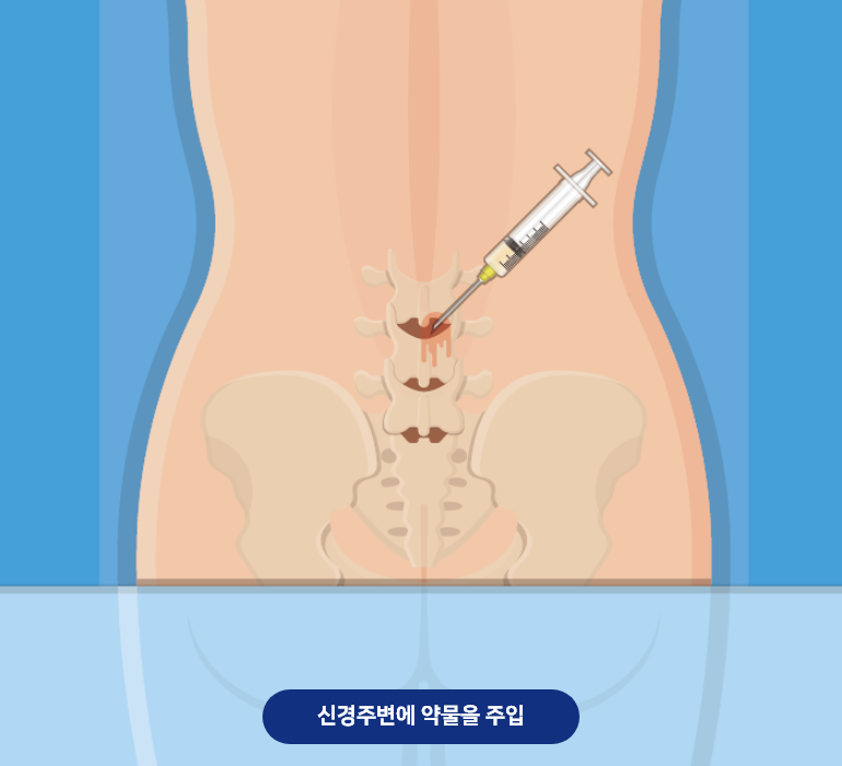 허리디스크 신경주사
