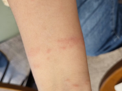 빈대 퇴치 물림 증상