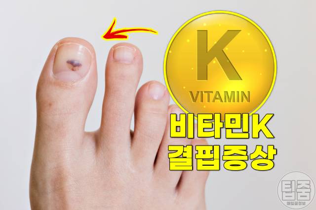 팔 다리 멍 자주 생기는 이유 멍원인 비타민k 철분