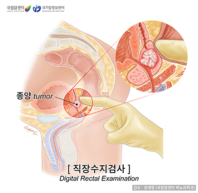 직장수지검사(DRE)