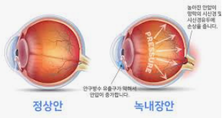 녹내장 안구