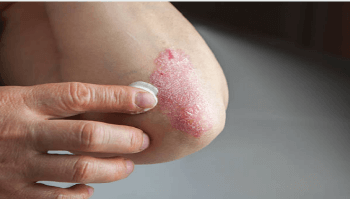 피부 건조 각질