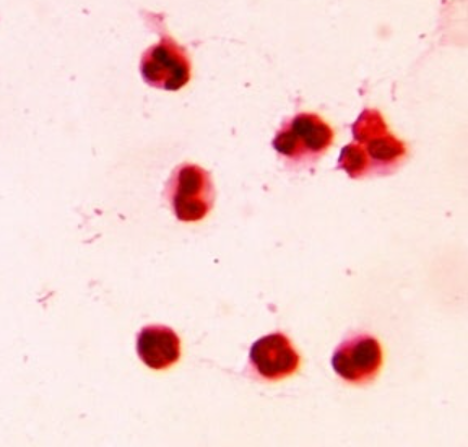 비임균성 요도염이란
