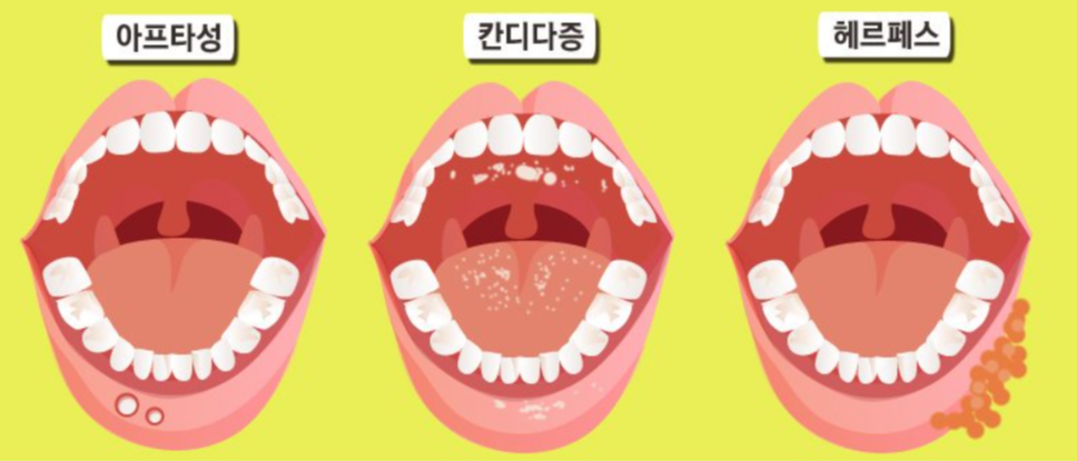 구내염의 종류