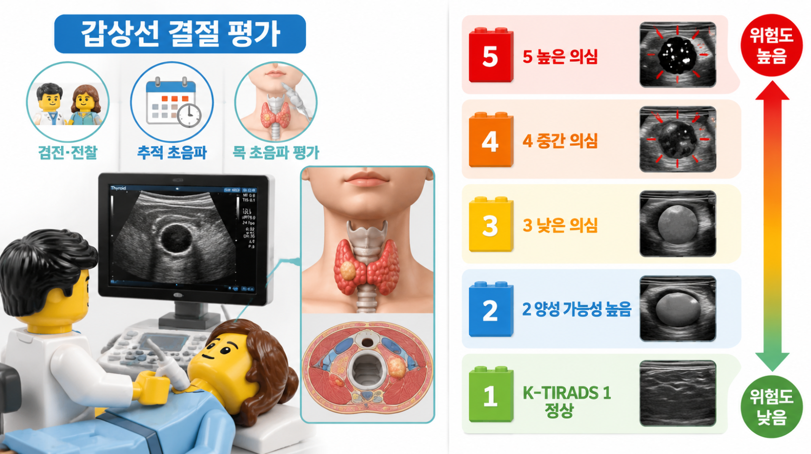 갑상선 결절 발견 후 K-TIRADS 1~5단계 의미를 보여주는 단계별 의료 인포그래픽