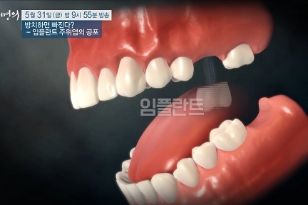 임플란트주위염