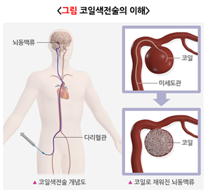뇌동맥류-치료-코일색전술