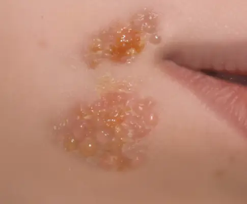 대상포진-무료접종-대상-가격-저렴한-병원-찾기-건강