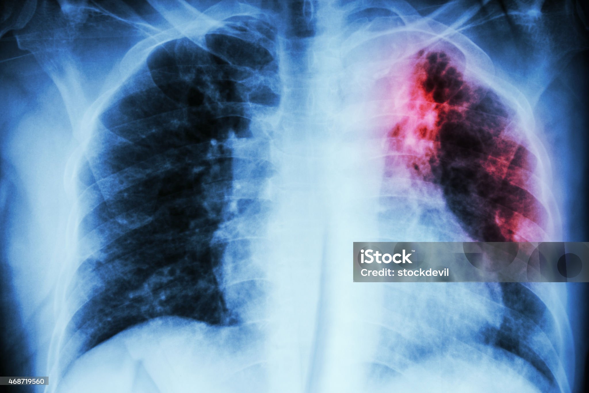 결핵 관련 사진