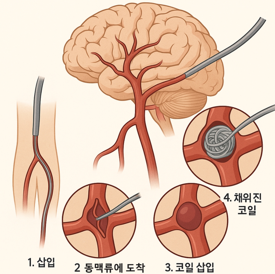 코일 색전술 시술과정