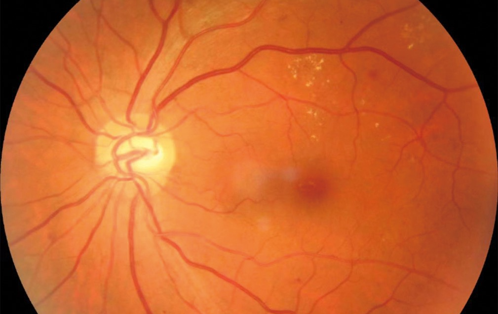 당뇨망막병증, 원인, 진행 과정, 치료 예방