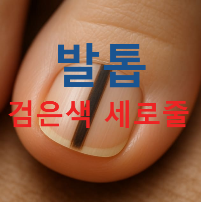 발톱 검은색 세로줄, 단순 멍일까? 흑색종일까?